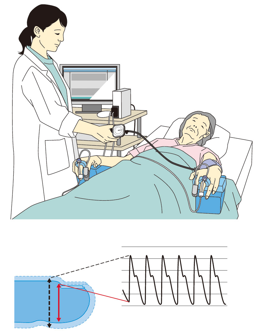 ⓔ図9-2-15　指尖容積脈波を用いた反応性充血による血管内皮機能指数 (RH–PAT) 