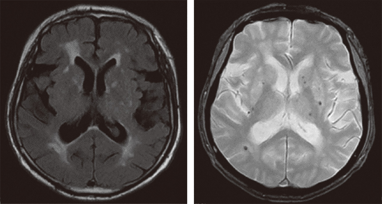 ⓔ図9-2-6　脳MRI検査にみられる高血圧性臓器障害の所見 (白質病変やmicrobleeds) MRI画像において，左のFLAIR (フレア) 像では，脳室周囲や深部白質に，慢性の虚血性変化として，高信号域を散在性に認める．右のT2＊(T2スター) 像では，深部白質に点状の低信号域としてmicrobleeds (微小出血) を認める．いずれも脳にみられる高血圧性臓器障害の所見である．