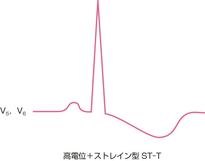 ⓔ図9-2-8　心電図におけるストレインパターン 体表面12誘導心電図の左側胸部誘導V5～V6において，左室高電位に加えて，左右対称でない陰性T波を認めるとき，ストレインパターンとよぶ．高電位＋ストレイン型ST–Tは，心電図における左室肥大の所見である．