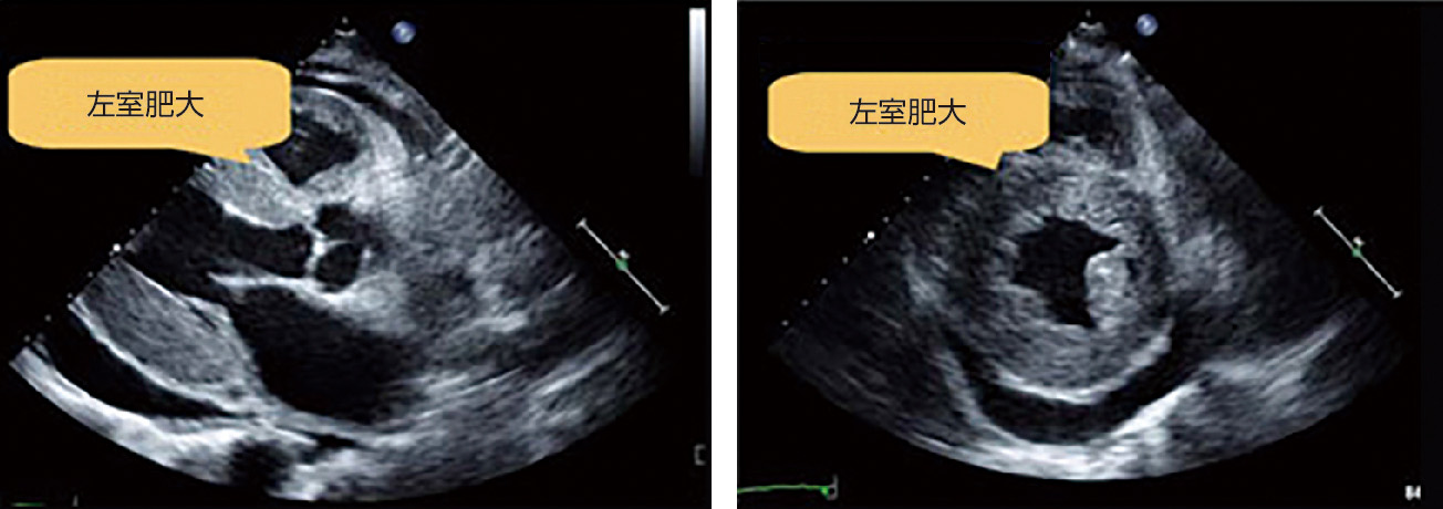 ⓔ図9-2-9　心臓超音波における左室肥大 左図は長軸，右図は短軸．心室中隔と左室後壁11 mm以上の左室肥大を認める．