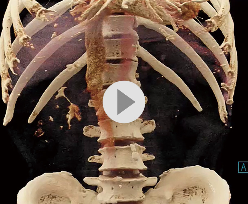 ⓔ動画12-1-2　腹部動脈血行動態の三次元画像  https://vimeo.com/657267886/00116fc2d0
