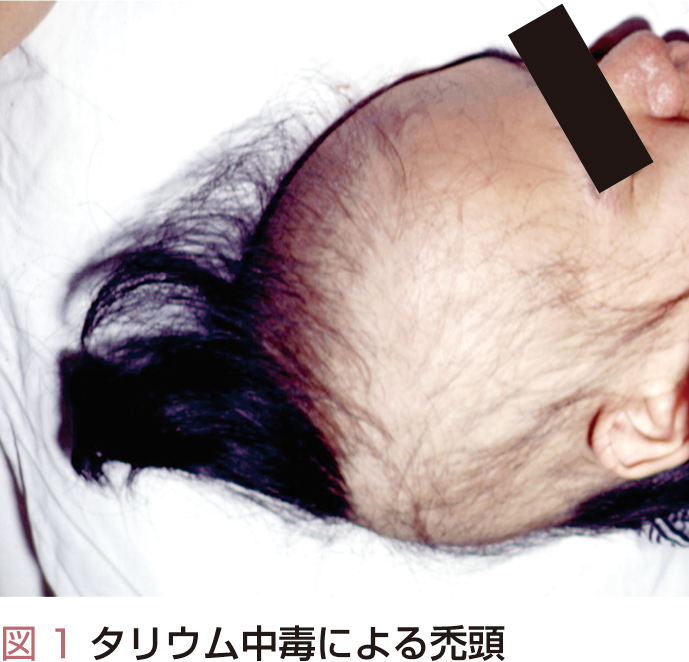 ⓔ表18-11-1b　タリウム中毒による禿頭 